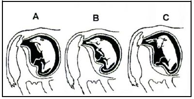 66 Calves that are incorrectly positioned before and during the time of parturition